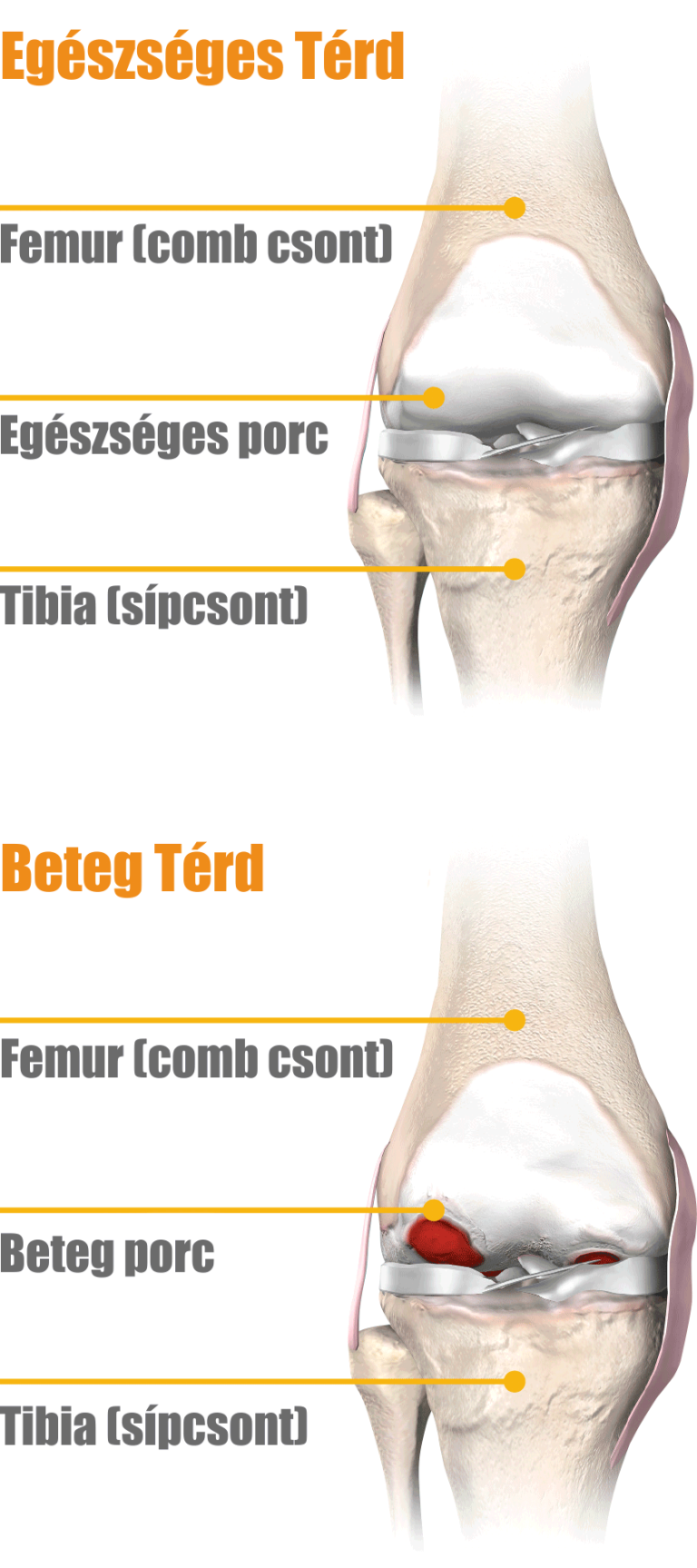ortopéd artrózis kezelés)